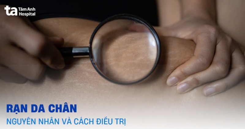 Rạn da chân: Hình ảnh, nguyên nhân và cách điều trị hiệu quả