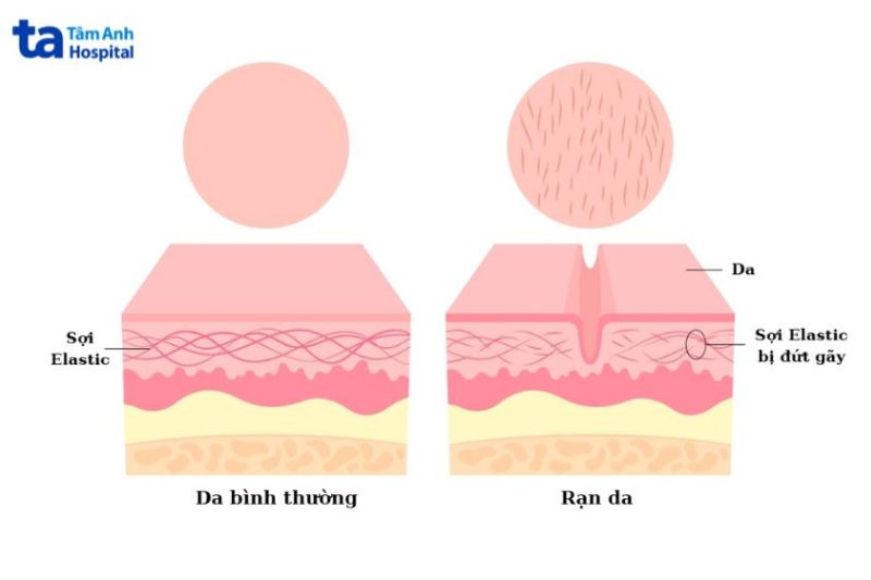 rạn da mông xảy ra khi da bị kéo căng quá mức