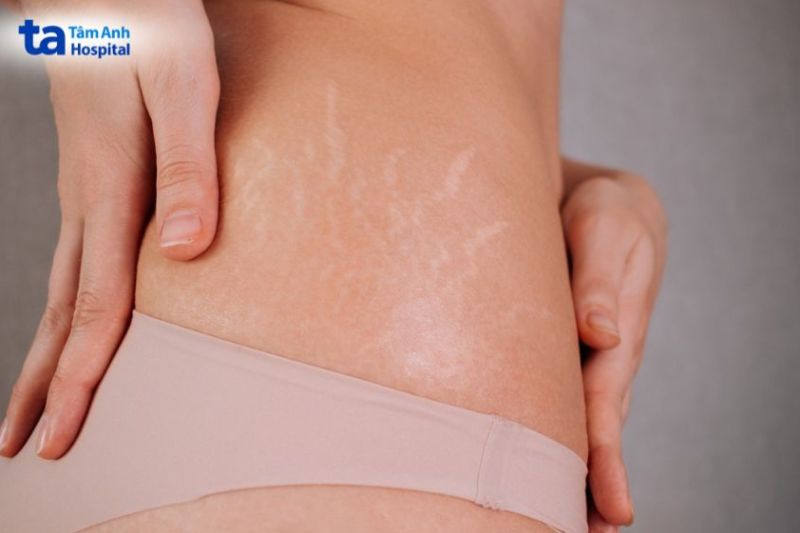 thiếu hụt collagen làm rạn da ở mông