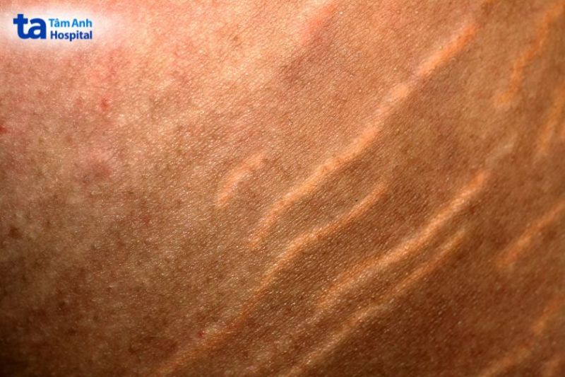 rạn da mông có màu đỏ, tím hoặc hồng