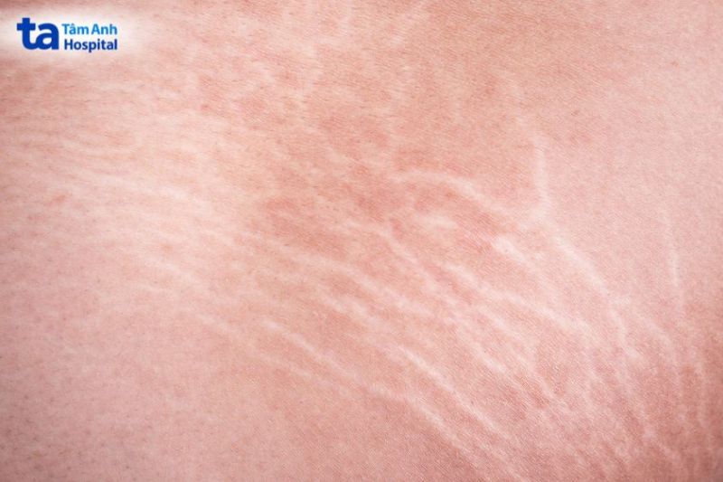 da rạn ở mông xảy ra ở tuổi dậy thì