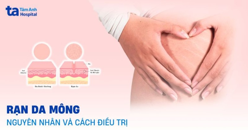 Rạn da mông: Nguyên nhân và cách điều trị tại nhà hiệu quả
