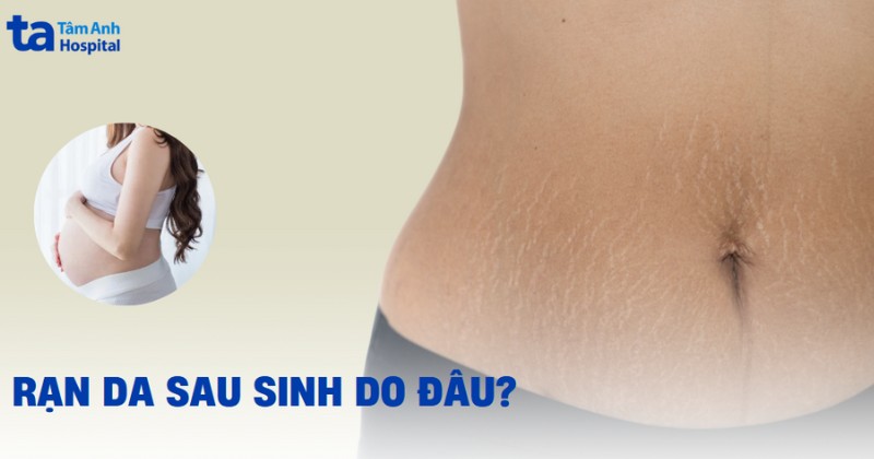 Rạn da sau sinh do đâu? 12 cách điều trị an toàn và hữu hiệu