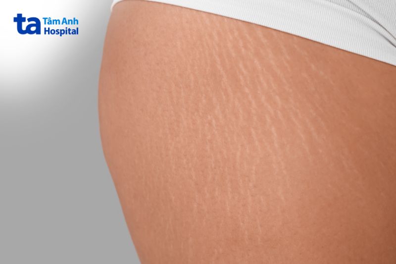 rạn da đùi tuổi dậy thì