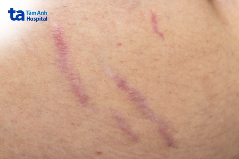 hình ảnh vết rạn da đỏ