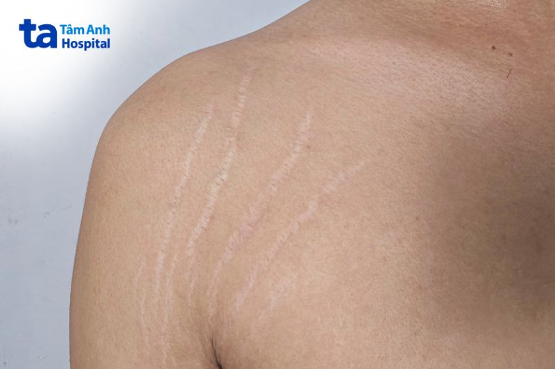 hình ảnh rạn da ở vai