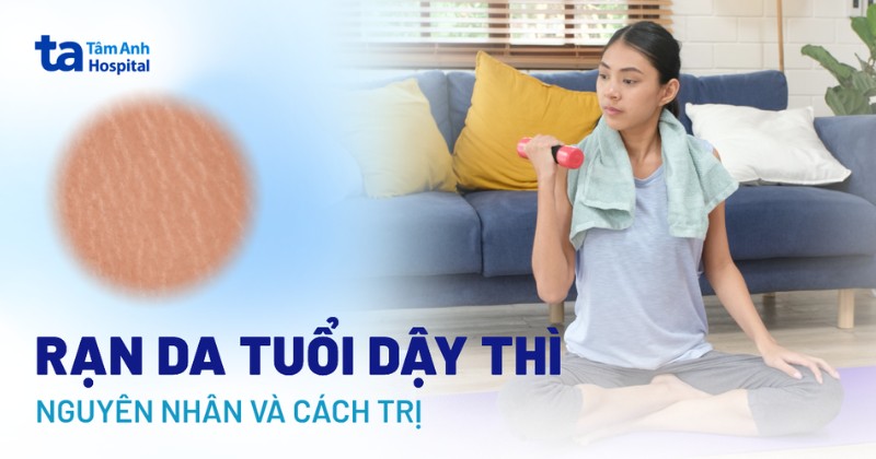 Rạn da tuổi dậy thì: Hình ảnh và nguyên nhân do đâu?