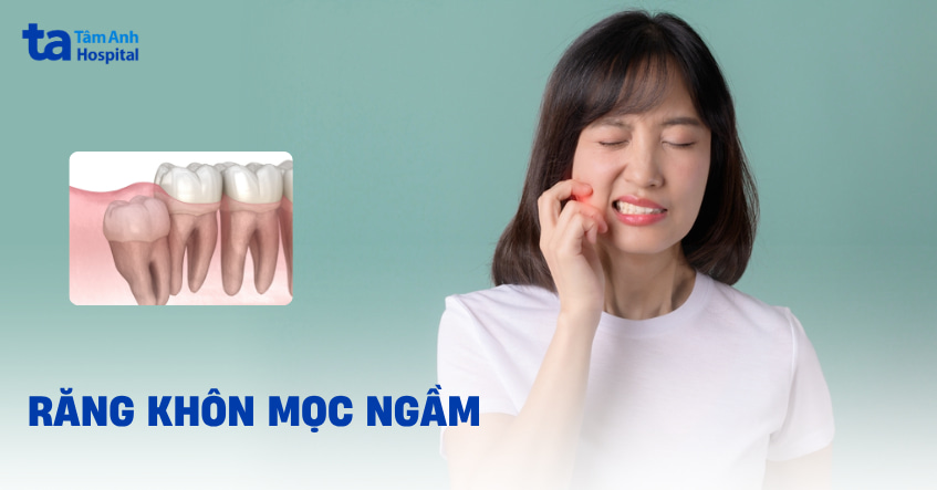 Răng khôn mọc ngầm là gì? Có nguy hiểm không? Khi nào nên nhổ?