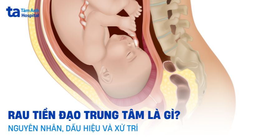 Rau tiền đạo trung tâm là gì? Nguyên nhân, dấu hiệu và xử lý