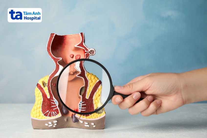 rò hậu môn trực tràng