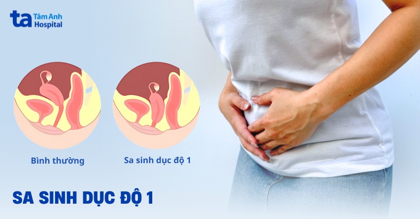 Sa sinh dục độ 1: Nguyên nhân, đặc điểm và cách điều trị dứt điểm