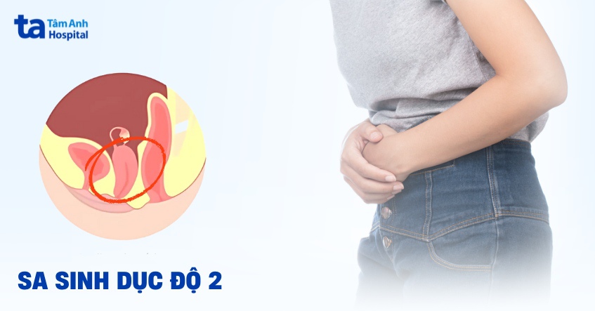 Sa sinh dục độ 2: Nguyên nhân, triệu chứng và cách điều trị dứt điểm