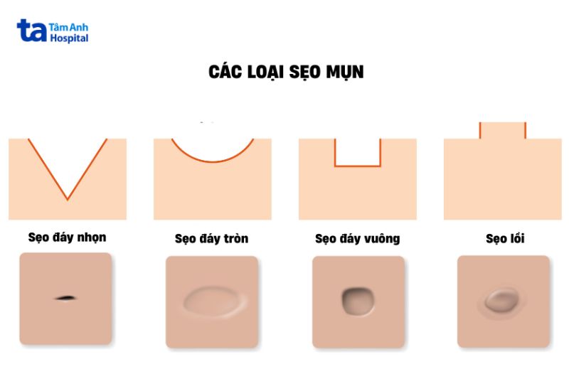 hình dáng của các loại sẹo mụn