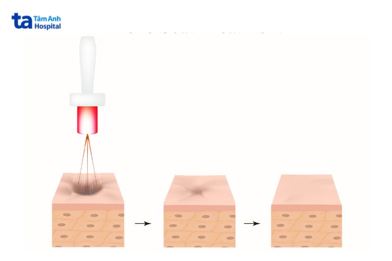 trị lỗ chân lông to bằng laser kích thích