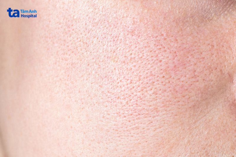 lỗ chân lông to do nhiều nguyên nhân khác nhau