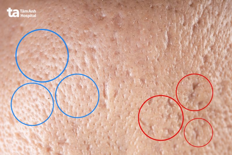 phân biệt lỗ chân lông to và sẹo đáy nhọn