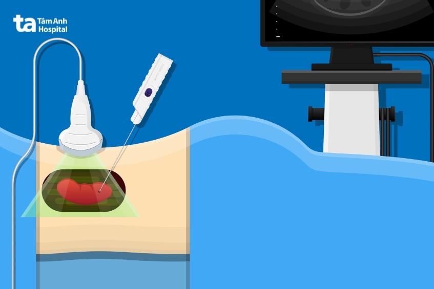 sinh thiết là xét nghiệm khẳng định ung thư thận