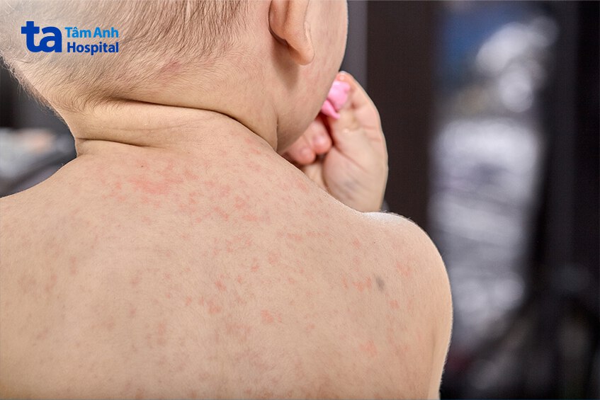 Sốt virus ở trẻ sơ sinh thường xuất hiện vào thời điểm giao mùa