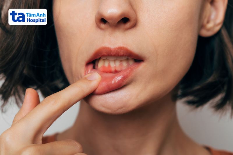 chảy máu chân răng là triệu chứng sốt xuất huyết