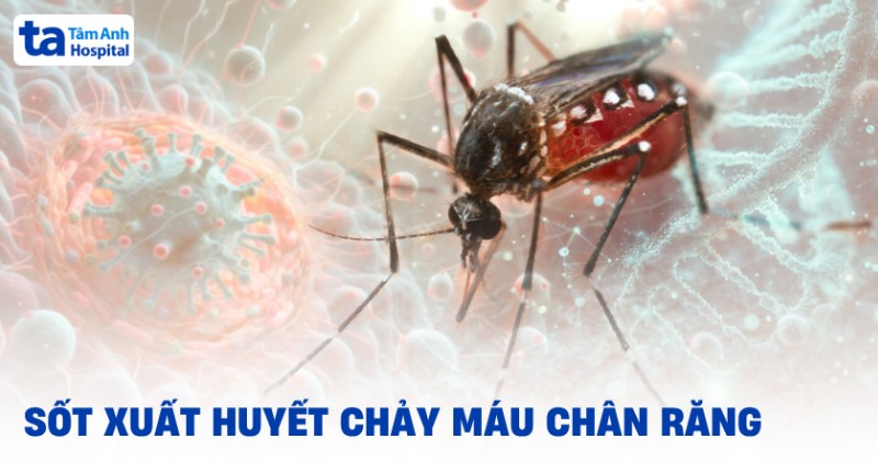 Sốt xuất huyết chảy máu chân răng nguy hiểm không? Cách điều trị