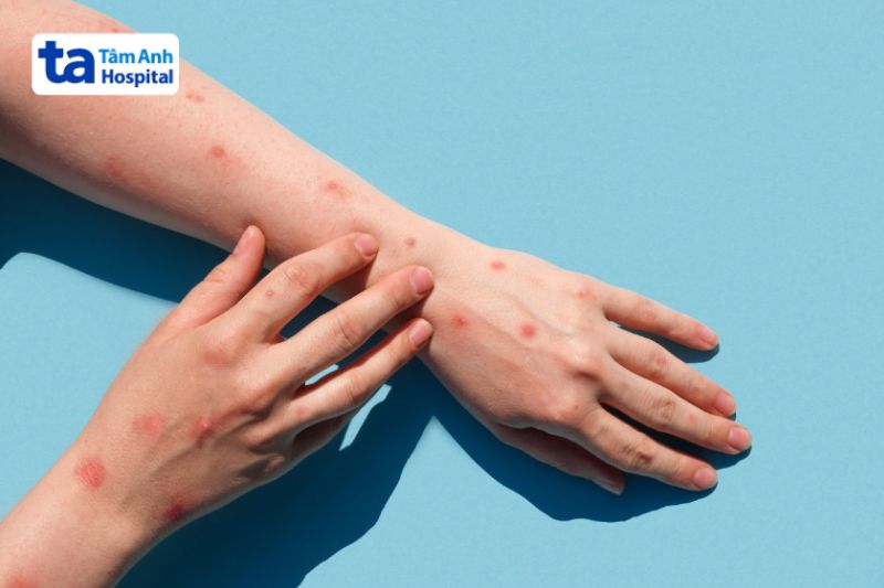 sốt xuất huyết nổi mẩn đỏ không nguy hiểm