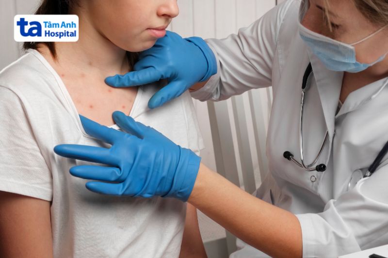 ban đỏ xuất hiện khi bị sốt xuất huyết