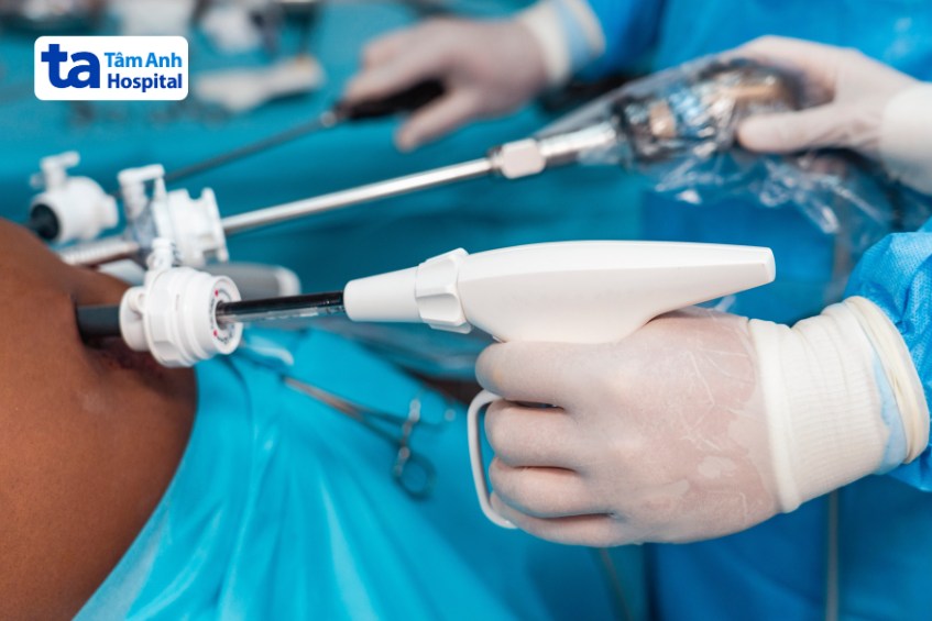 sử dụng trong mổ nội soi ruột thừa ở trẻ em