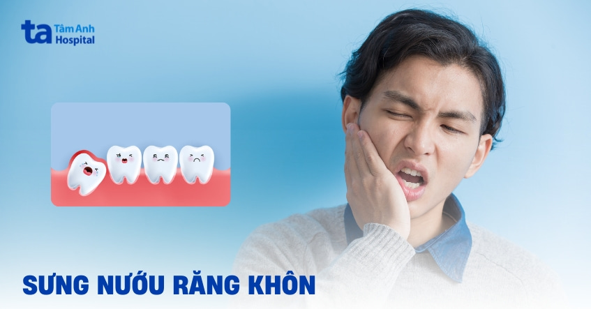 Sưng nướu răng khôn: Nguyên nhân, dấu hiệu và cách giảm sưng