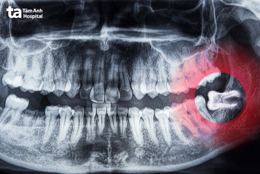 sưng nướu răng số 8