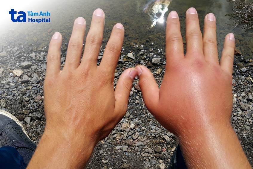 tác dụng phụ khi dùng arcoxia 90mg