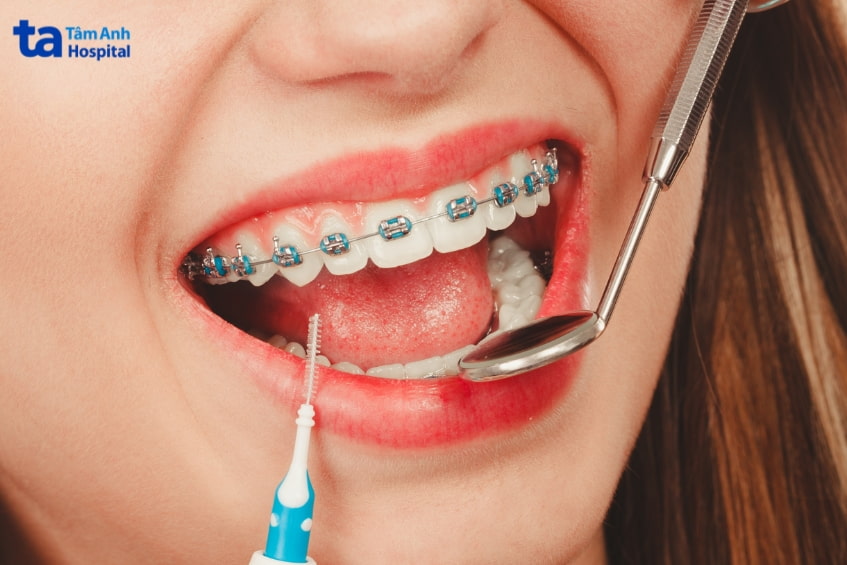 tác hại của tẩy răng