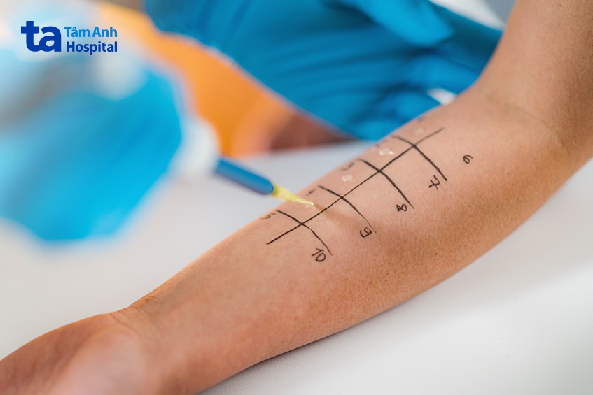 test lẩy da kiểm tra dị ứng thuốc tê