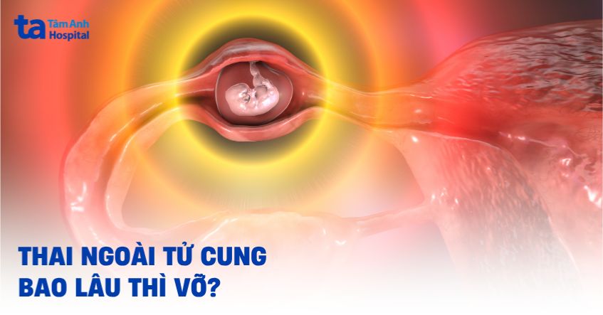 Thai ngoài tử cung bao lâu thì vỡ? Các triệu chứng nhận biết
