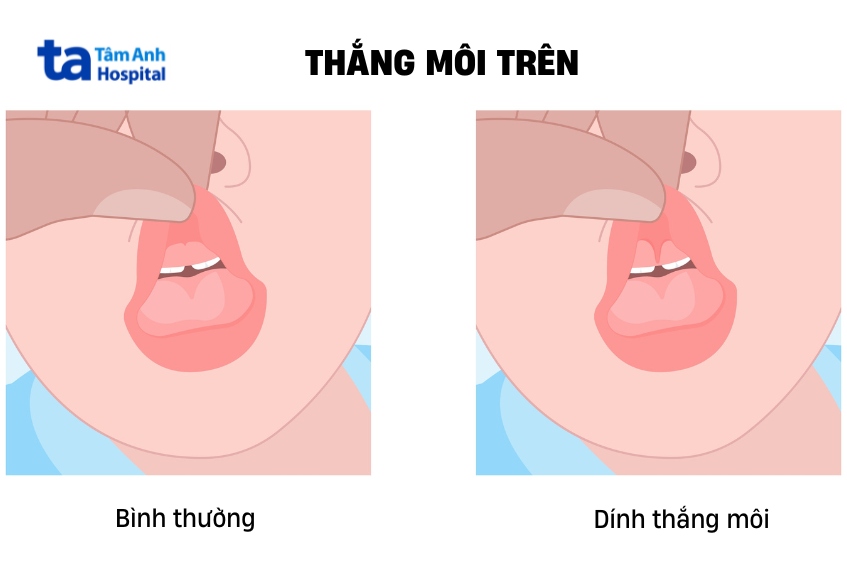 Thắng môi bình thường và dính thắng môi trên