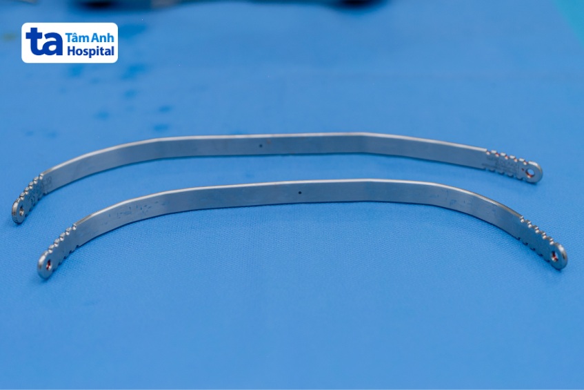 thanh nâng ngực được rút ra khỏi người bệnh nhi