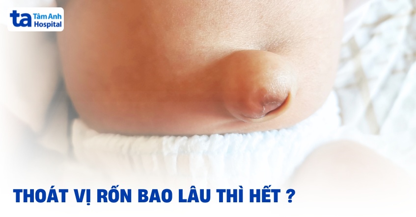 Thoát vị rốn bao lâu thì hết? Yếu tố ảnh hưởng thời gian khỏi bệnh