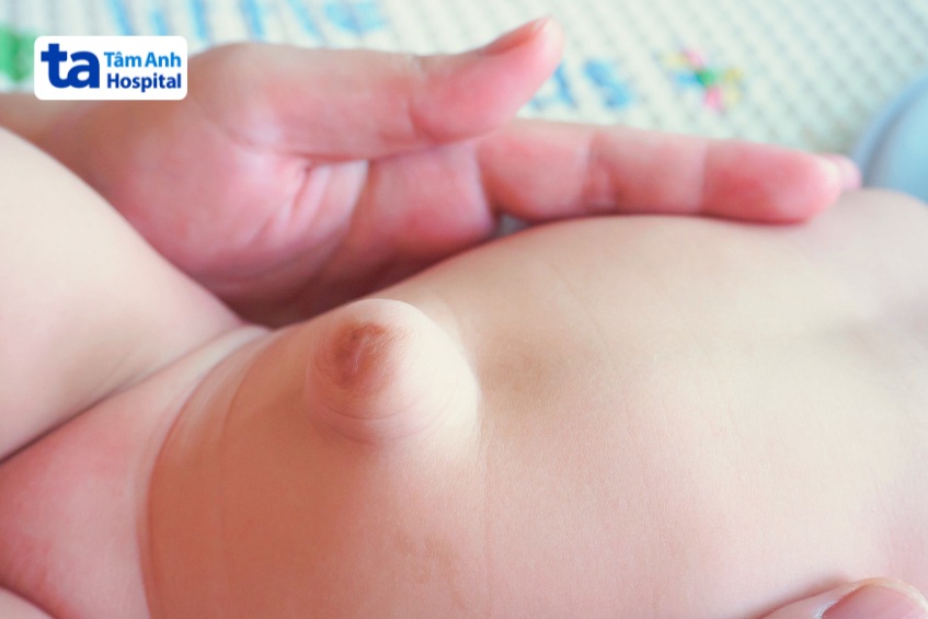thoát vị rốn là bệnh lý thường gặp ở trẻ sơ sinh