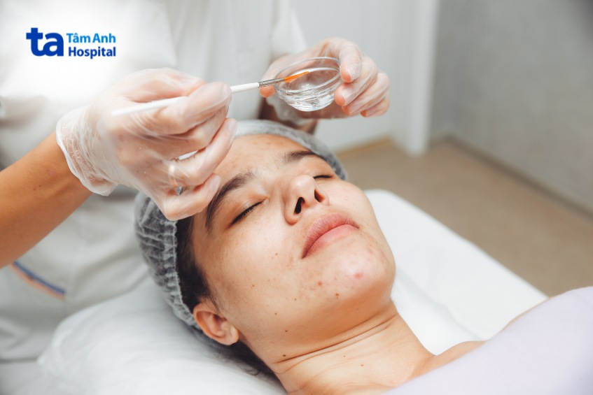 thời gian có thể tiêm meso sau peel