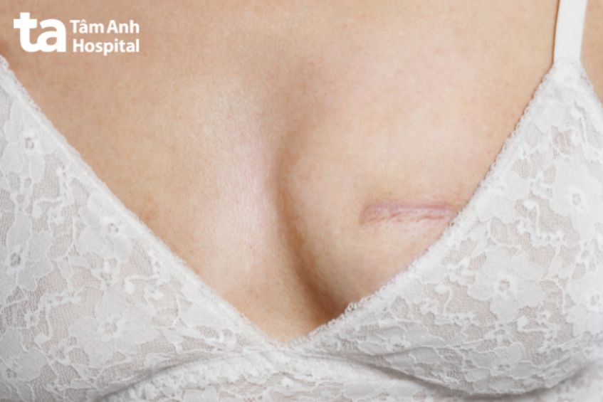 Thời gian lành sau khi mổ u vú