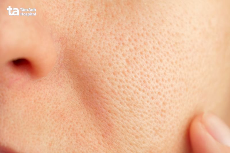 lỗ chân to làm mất thẩm mỹ