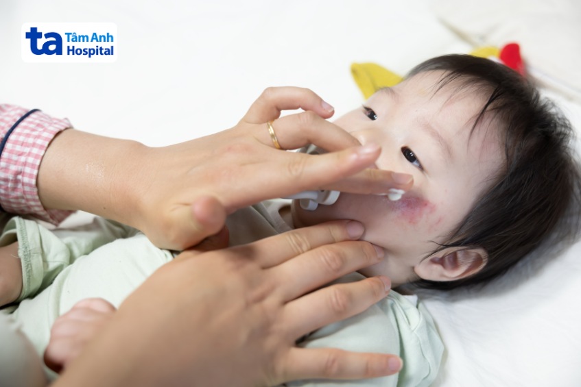 thuốc bôi có thể gây ra tình trạng dị ứng ở trẻ bị tay chân miệng