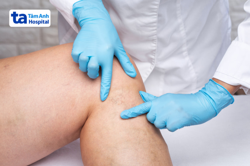 Chỉ định của Diosmin