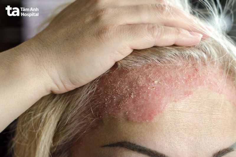 viêm da tiết bã do nấm Malassezia gây ra