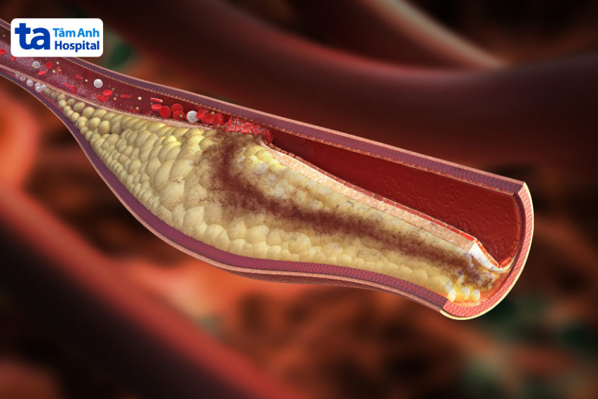Tích tụ mảng xơ vữa càng nhiều càng gây hẹp mạch vành, thậm chí dẫn đến tắc nghẽn hoàn toàn