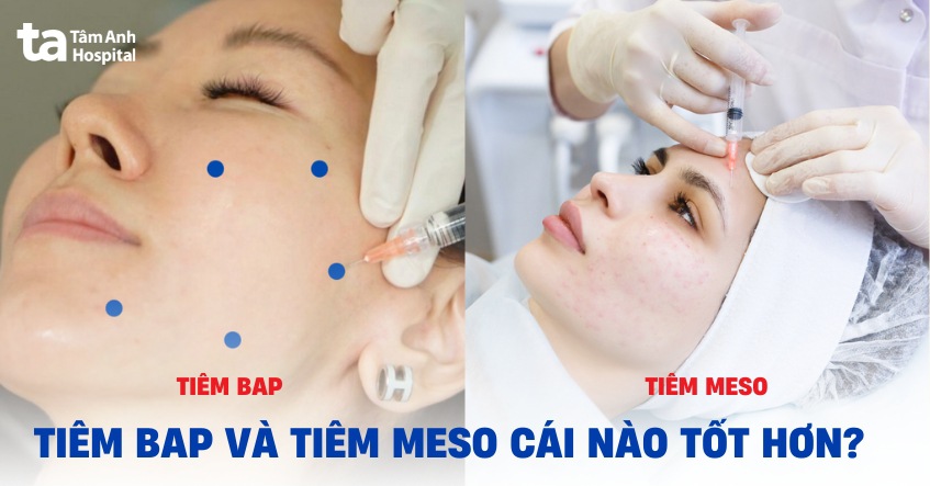 Tiêm BAP và tiêm meso khác nhau như thế nào? Cái nào tốt hơn?