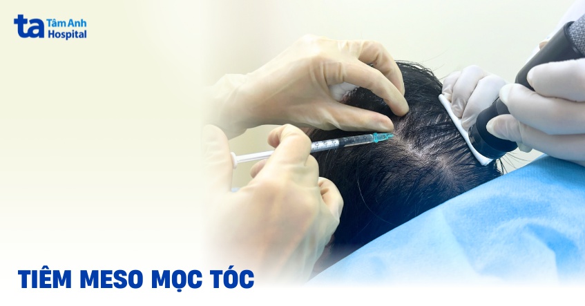 tiêm meso mọc tóc có hiệu quả không