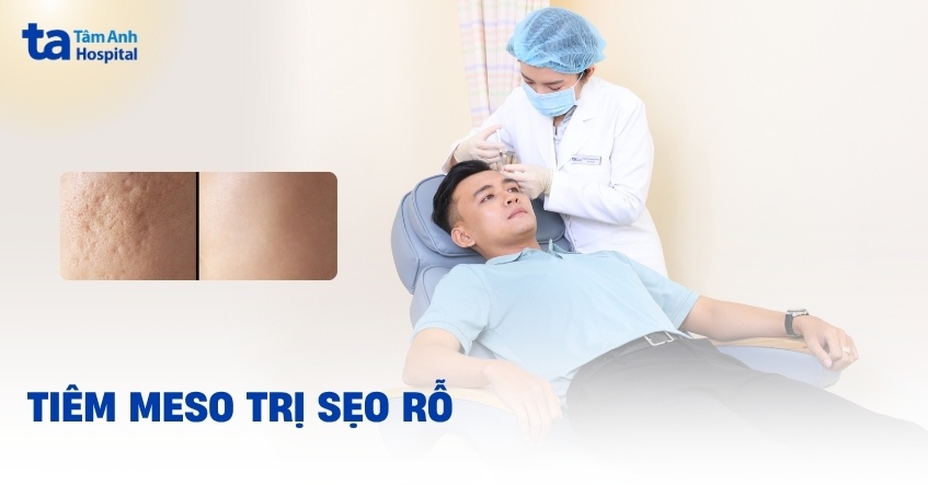 tiêm meso trị sẹo rỗ có tốt không