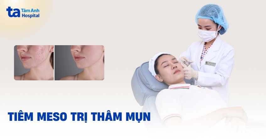 tiêm meso trị thâm mụn giá bao nhiêu