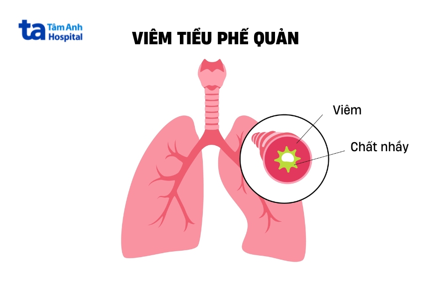 tiểu phế quản sưng viêm