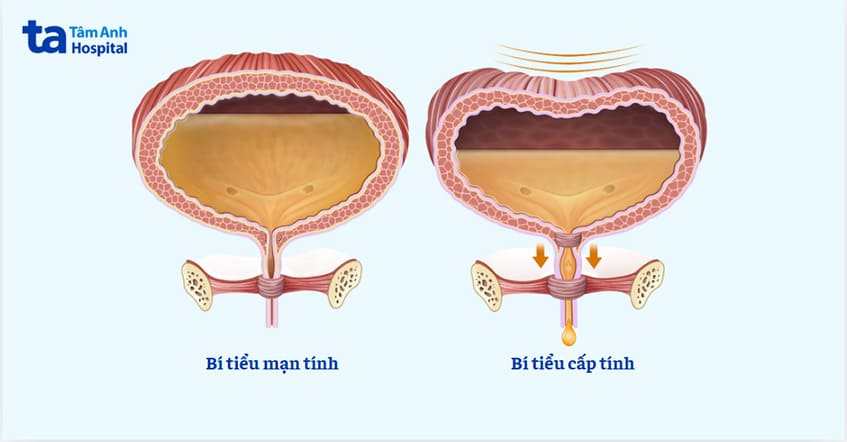là tình trạng bàng quang không trống hoàn toàn hoặc không thể đi tiểu